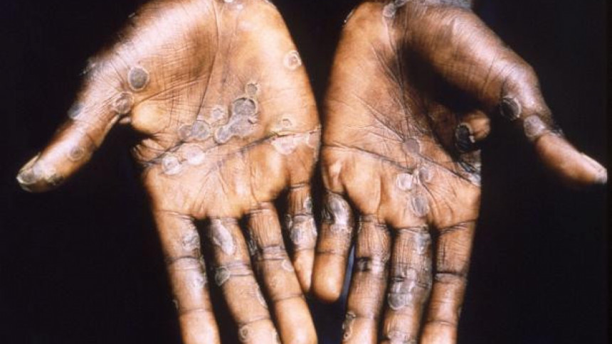 Monkeypox: Screening to start at airports, land ports Monkeypox: Screening to start at airports, land ports