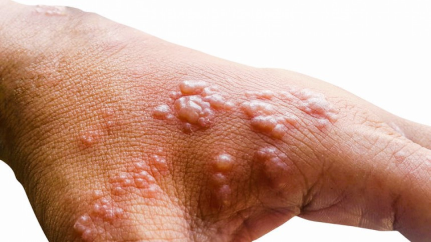 Man with no foreign travel history tests positive for monkeypox in Delhi monkeypox outbreak India