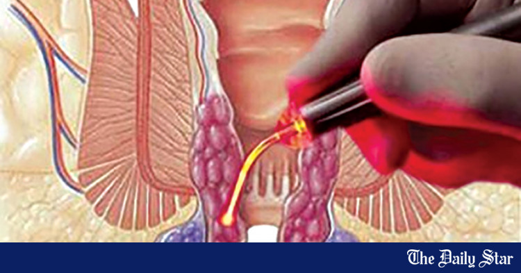 Laser in hemorrhoid treatment: A novel, safe and promising approach